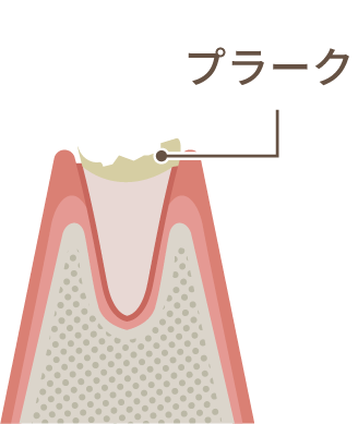 プラークの付着した歯のイラスト