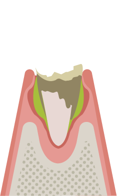 骨が溶け出した歯のイラスト